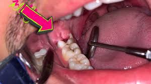 Gigi premolar dan gigi geraham yang notabene merupakan gigi bagian belakang lebih rentan berlubang. Cabut Geraham Bungsu Berlubang Dentist Dokter Gigi Tri Putra Youtube