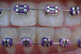 Black And Baby Blue Braces Dark And Light Purple Braces Cute Braces Colors Cute Braces Braces Colors Combinations