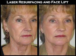 A Reason To Be Thankful Turkey Neck Treatments That Work California Skin Institute
