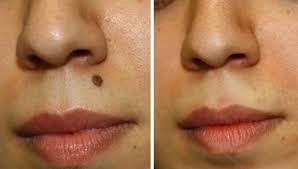 10 Natural Home Remedies To Get Rid Of Moles On Your Face Moles On Face Skin Moles Mole Removal