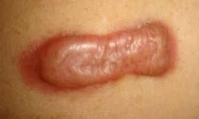 A scar that grows beyond the boundaries of the original wound is called a keloid scar whereas a scar that is raised above the skin level but grows within the boundaries of the original wound is known as a hypertrophic scar. Hypertrophic Scars Keloid The Aesthetic Loft