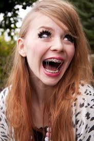 Interarch elastic bands are longer than braces ligatures and are used to help fix a misaligned bite. Pin On Beugels