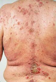 In the early stages of cervical cancer, a person may experience no symptoms at all. Dermatologic Signs Of Systemic Disease