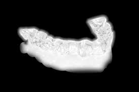 Gratis zahnspange für kinder und jugendliche bis zum vollendeten 18. Was Ist Orthocaps Das Twin Aligner System Die Unsichtbare Zahnspange Von Orthocaps