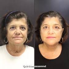 Dr. John Thomassen Plastic Surgery (@drthomassenmd) · Fort Lauderdale, FL