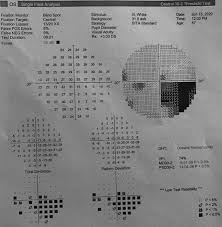 Image result for Visual Field Deficit