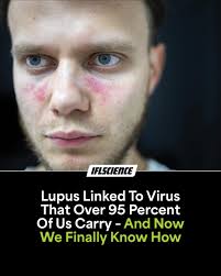 We think it applies to 100% of lupus cases."