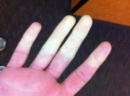 Maladie De Raynaud Voici Un Remede De Grand Mere Qui Aide Enormement Maladie De Raynaud Remede De Grand Mere Malade