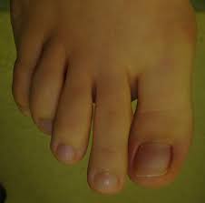 Je me suis pris le pied dans la porte et mon petit doigt est tout rouge gonglé un gros hematome noir pensez vous que c est utile de consulter car . Orteils En Griffe Chirurgie Du Pied