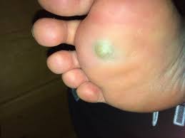 Maybe you would like to learn more about one of these? Dark Blood Blister On The Fore Pad Of My Foot Too Painful To Stand On Practically Popping