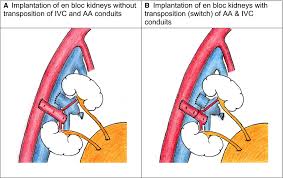 Renal Transplant From Infant And Neonatal Donors Is A Feasible Option For The Treatment Of End Stage Renal Disease But Is Associated With Increased Early Graft Loss Wijetunga 2018 American Living donors may be related or unrelated to the patient, but a related donor has a better chance of having a kidney that is a. renal transplant from infant and