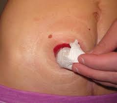 When there is itching all over body with no rash development, then the affected person can be mystified about the cause of itchiness. Skin Sleuthing Ostomy Outdoors