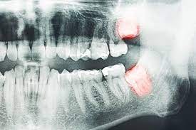 Signs and symptoms of an infection if you begin seeing any of the following signs, it could be a pointer to developing an infection. Wisdom Tooth Removal Facts You Need To Know Naenae Dental
