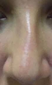 Denkt Ihr Meine Nase Ist Gebrochen Gesundheit Und Medizin Beauty