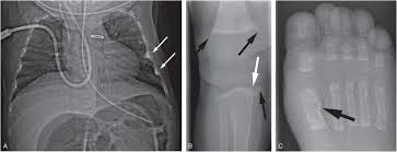 Differential Diagnosis Ii Disorders Of Calcium And Phosphorus Metabolism Radiology Key