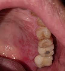 When to see a doctor for a blood blister? Possible Signs Of Covid 19 In The Mouth