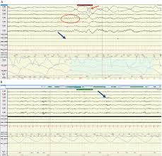 Image result for REM Sleep Behavior Disorder