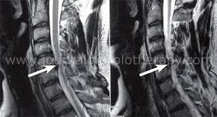 Non Operative Treatment Of Cervical Radiculopathy A Three Part Article From The Approach Of A Physiatrist Chiropractor And Physical Therapists Journal Of Prolotherapy