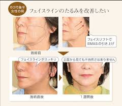 フェイスリフト SMAS法｜ヒルズ美容クリニックは神奈川・湘南・藤沢の美容外科・美容皮膚科・形成外科