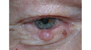 Learn about the academy's efforts to refocus its brand on education. Eyelid Skin Cancer Mivision