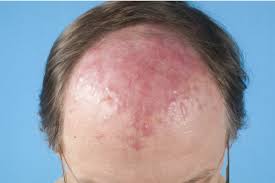 Some of the same chemotherapy treatments that people receive are suitable for dogs with lymphoma. Primary Cutaneous Follicle Center Lymphoma Download Scientific Diagram
