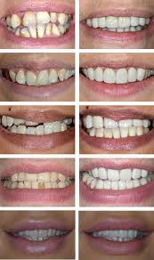 Their cosmetic dentistry was superb. Dental Veneers The Perfect Smile Studios 01992 552115