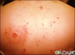 Skin cancer is the most common type of cancer in the united states by a pretty large margin, and it does not discriminate. Basal Cell Skin Cancer Information Mount Sinai New York