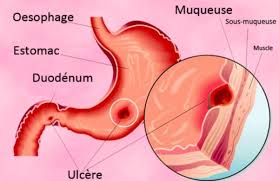 Ulceres Gastriques 9 Remedes Naturels Pour Les Soigner