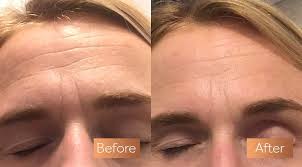 6 how long does it take for collagen supplements to work? Absolute Collagen Before And After Pictures Incredible Results
