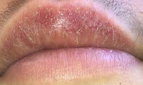Trockende Und Brennende Oberlippe Gesundheit Und Medizin Lippe Lippenpflege
