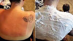 Essential oils such as lavender or helichrysum can be applied in small amounts to the skin to soothe sunburn. How Shaving Cream Can Help You Get Rid Of A Sunburn Youtube
