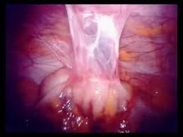 Conversely, ports placed >20 cm from ta makes it difficult to see or reach with robotic instruments. The Point About Palmer Youtube