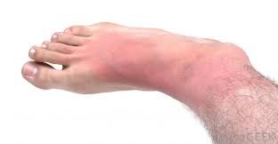 Blood clots are a collection of sticky blood cells that form when a blood vessel is damaged. What Are Some Blood Clot Symptoms With Pictures