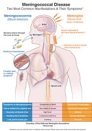 We did not find results for: What Are The Symptoms National Meningitis Association