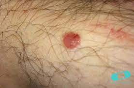 Fungal groin infection (tinea cruris) is a fungal skin infection of the groin. Basal Cell Carcinoma Basalioma Bcc Online Dermatology