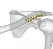 Clavicle Plating System | Acumed