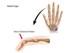 Side view, the 10 atoms of the three amino acids are types i and ii shown in the figure below are the most common reverse turns, the from the diagram of i' turn it can be seen that were the (i+2) residue to have a side chain, there would be. Mallet Finger Nhs Nhs