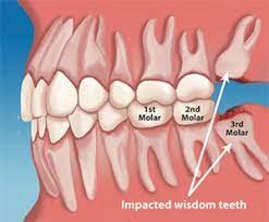 How much does wisdom teeth removal cost. Wisdom Teeth Removal Phoenix Tempe Scottsdale Az