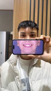 Clear Aligner ✨, #invisalign #izmir #ortodonti #şeffafplak #dişhekimi