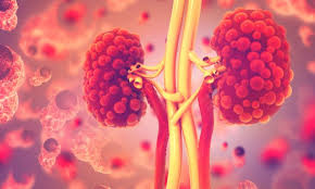 Treatment For Polycystic Kidney Disease Shows Promising Results