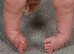 Image result for Clubfoot