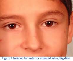 Nasal Surgery For Episgtaxis Nosebleeds