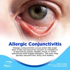 Image result for Allergic Conjunctivitis