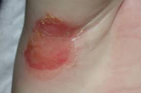 Image result for Intertrigo under breasts