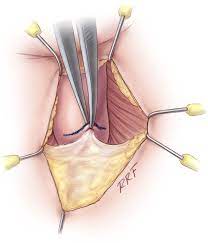 Advance Male Sling Surgical Technique And Postoperative Patient Management European Urology Supplements
