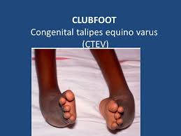 The foot or feet turn inward. Common Pediatric Foot Deformities Clubfoot Congenital Talipes Equino Varus Ctev Ppt Download