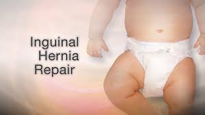 Image result for Inguinal hernia child