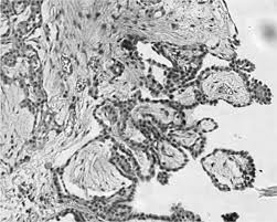 Am j surg pathol 2001; Well Differentiated Papillary Mesothelioma Clustering In A Portuguese Family With A Germline Bap1 Mutation Annals Of Oncology
