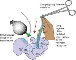 Image result for Delayed Transition from Fetal Circulation