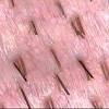 Hair follicles damaged by traction alopecia due to pulling can only be restored using hair transplantation. 1